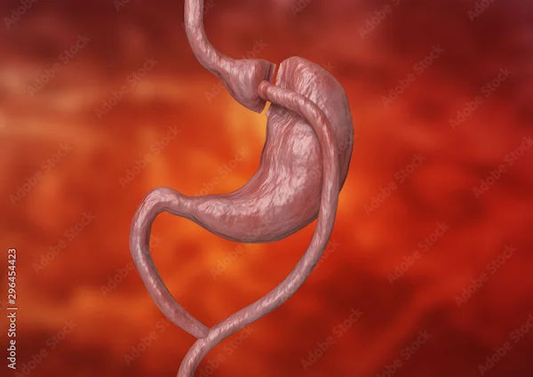 Recovery Time For Gastric Bypass Revision Surgery