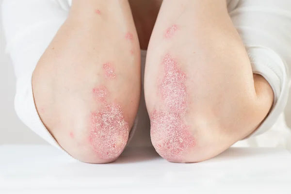 Elbow Psoriasis: Know About Its Causes, Symptoms, and Treatment