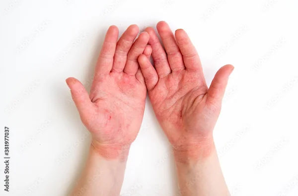 How to Reduce Swelling in Hand After IV?