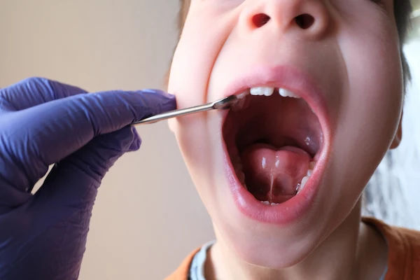Tongue Tie (Ankyloglossia): Everything You Need To Know