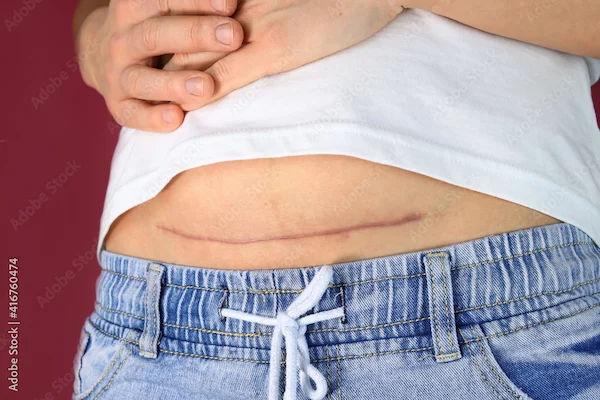 Can I Sit on Floor After Hysterectomy?