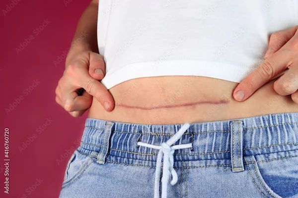 Laparoscopic Supracervical Hysterectomy Recovery