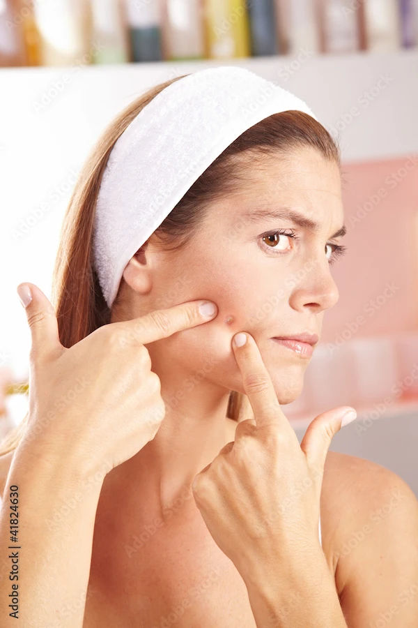 How To Reduce Pimples Naturally?