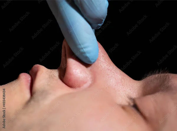 How To Reduce Nose Fat?