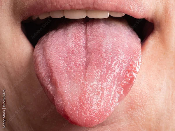 Tongue Cancer: Symptoms, Risk Factors, Treatment & Prevention