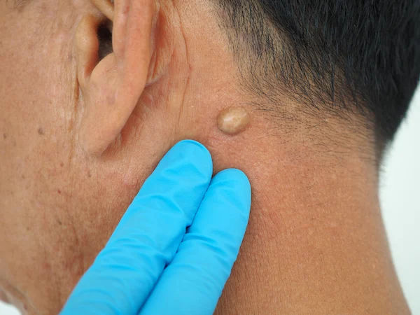 Understanding Lipomas: Causes, Symptoms, And Treatment Options