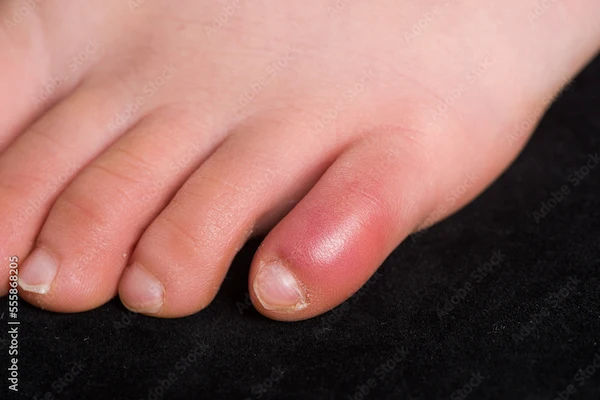 Understanding Chilblains: Causes, Symptoms, and Treatment