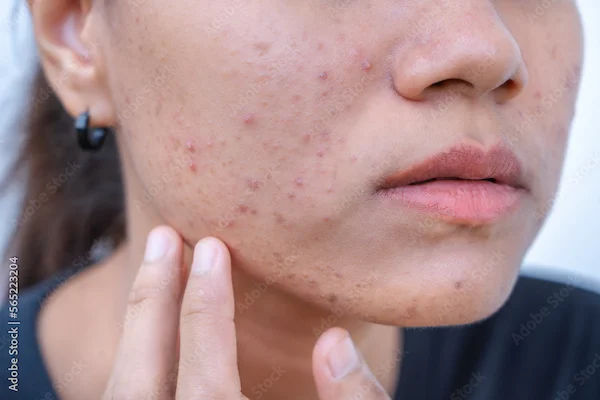 How To Reduce Pimple Marks?