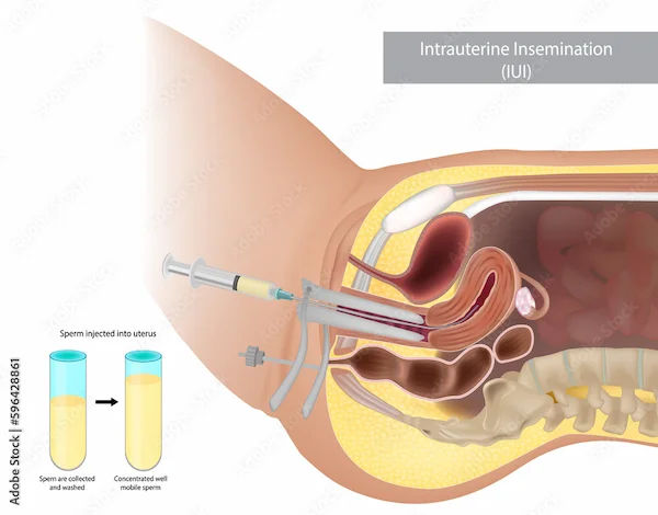 Understanding IUI: Risks, Success Rates And Uses