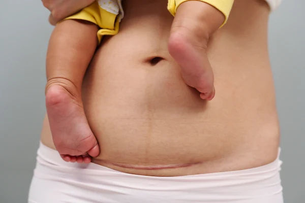 C Section Vs Hysterectomy Pain