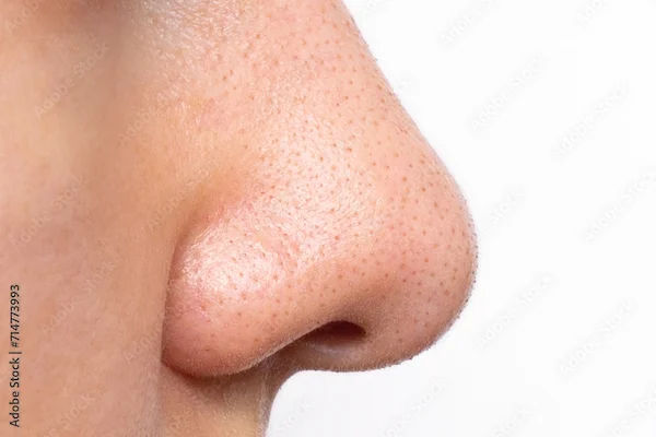 How To Reduce Blackheads?