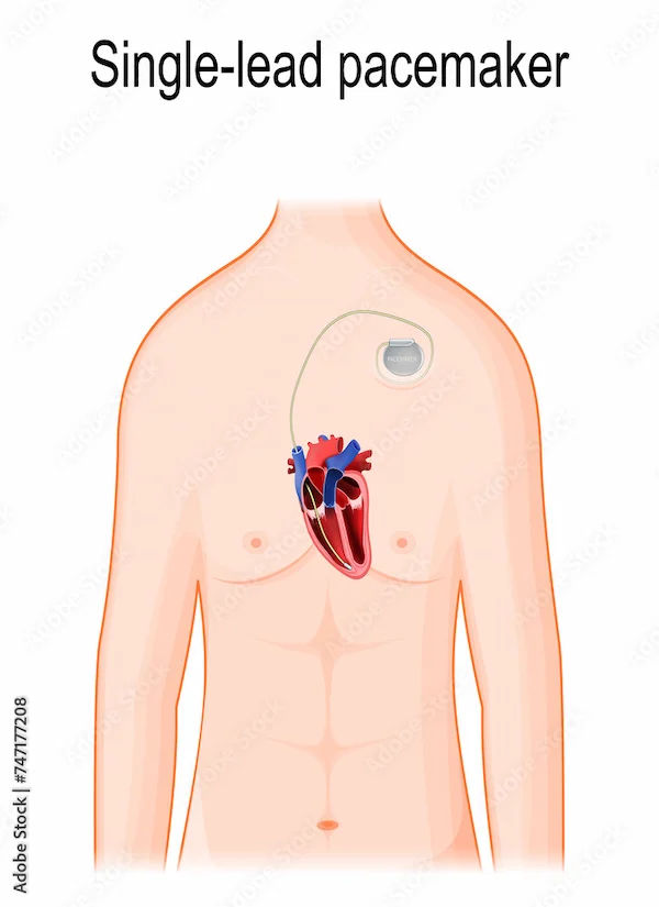 Understanding Pacemaker Complications: What You Need to Know