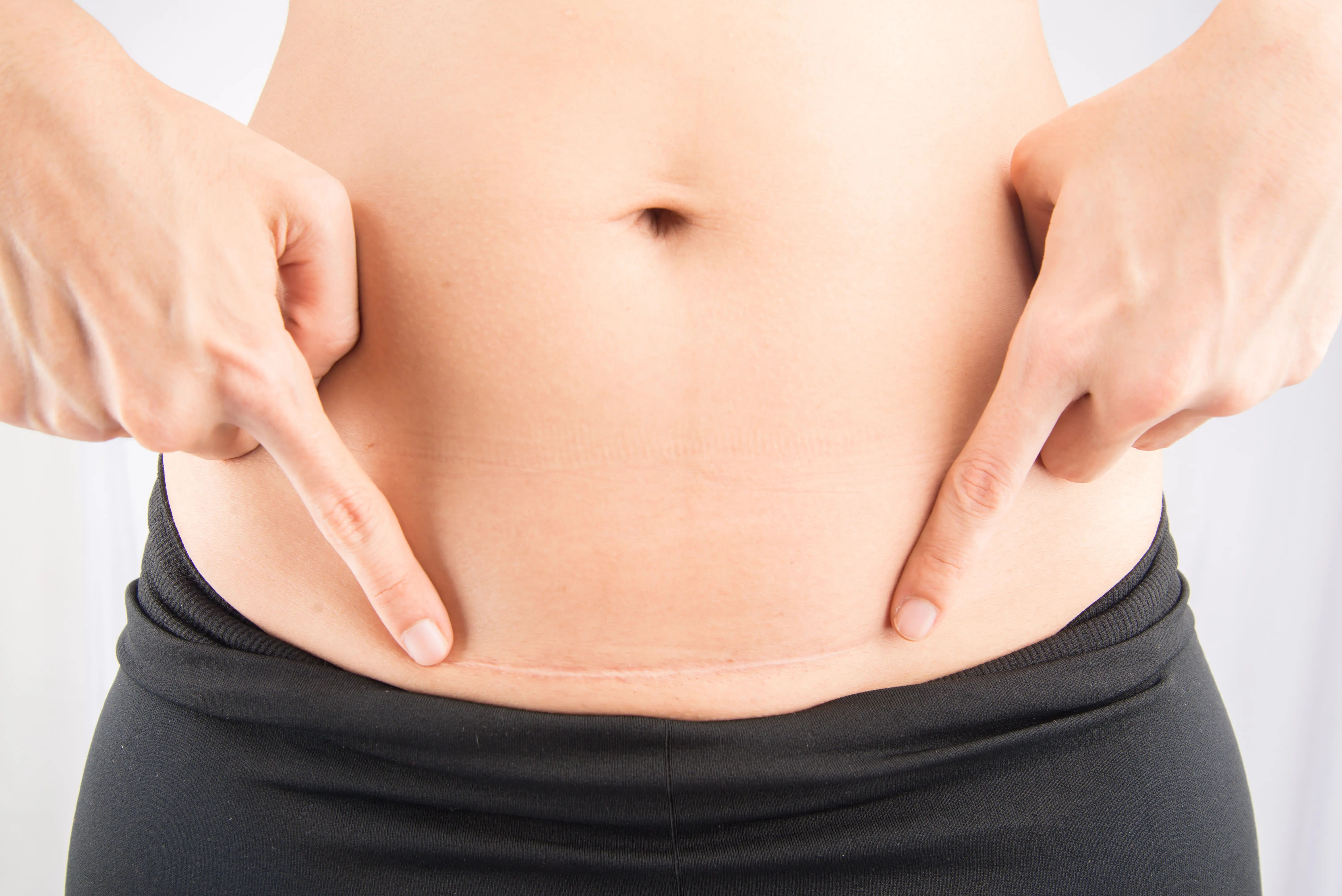 Reduce Belly Fat After C Section