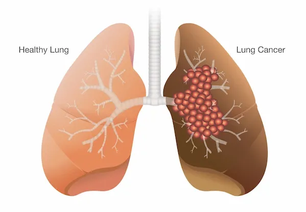 lung cancer