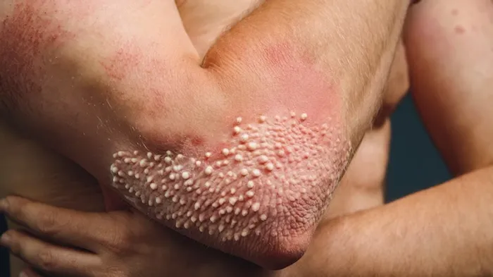 skin fungal infections