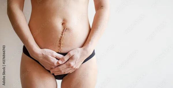 Personality Changes After Hysterectomy