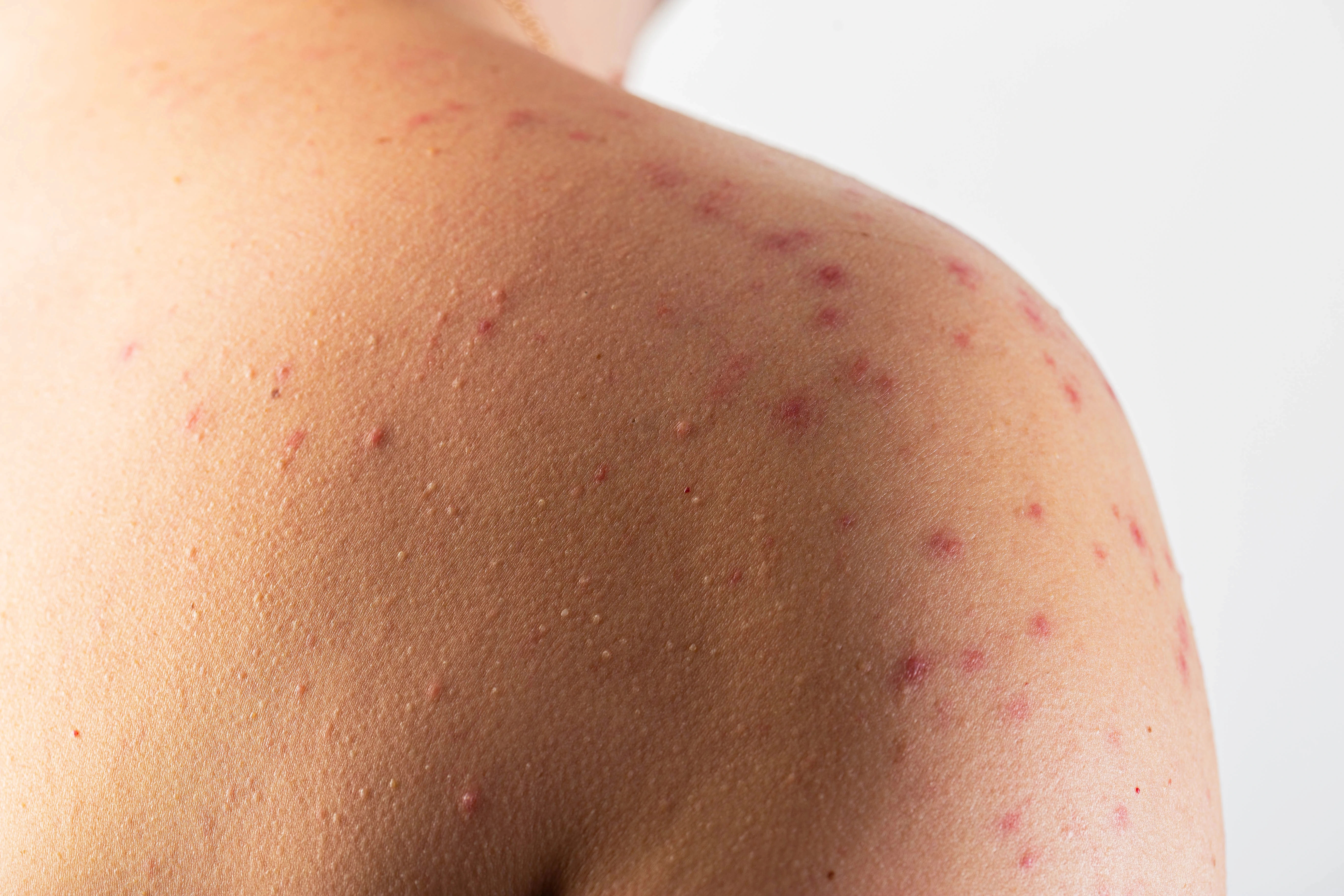 Sweating in Style? When Fashion Attacks Your Skin
