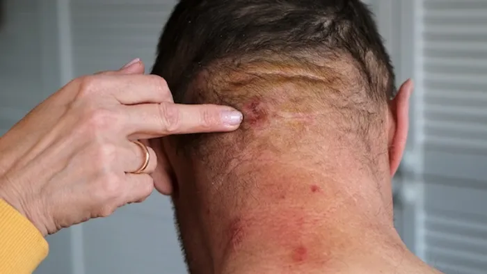 allergy cancer connection