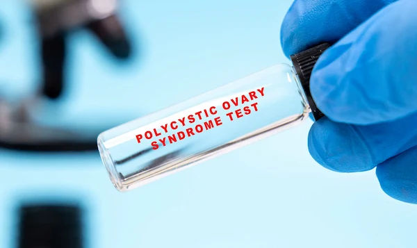 PCOS Blood Test Checklist for Women with Irregular Periods