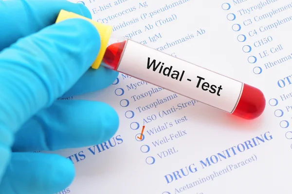 Typhoid Test Names and Details