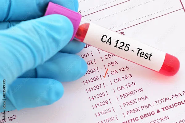 High CA125 After Hysterectomy