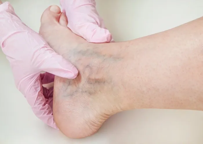 Deep Vein Thrombosis