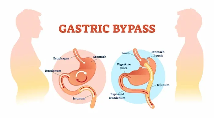 Foods To Avoid After Gastric Bypass Surgery