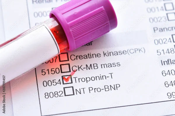 Causes of High Troponin Levels Explained