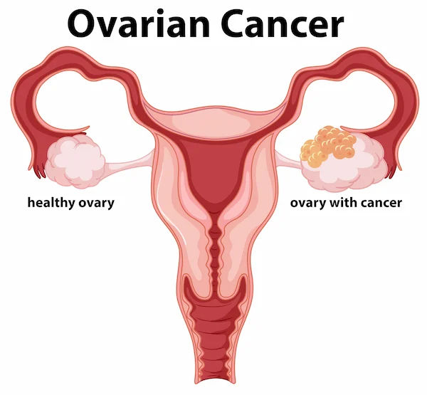 Will A Hysterectomy Cure Ovarian Cancer?