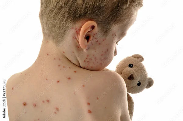 Monkeypox: Treatment and Management Options