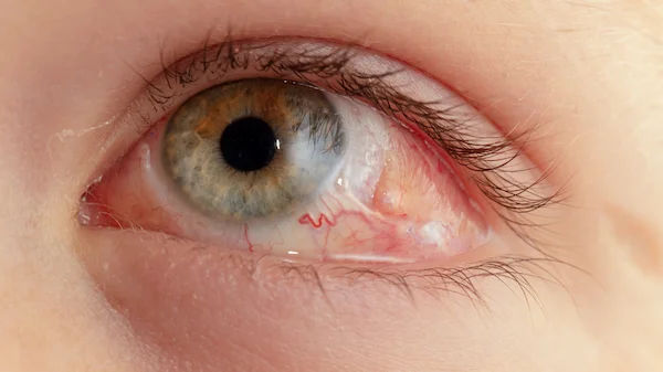 Cataract After Retinal Detachment Surgery