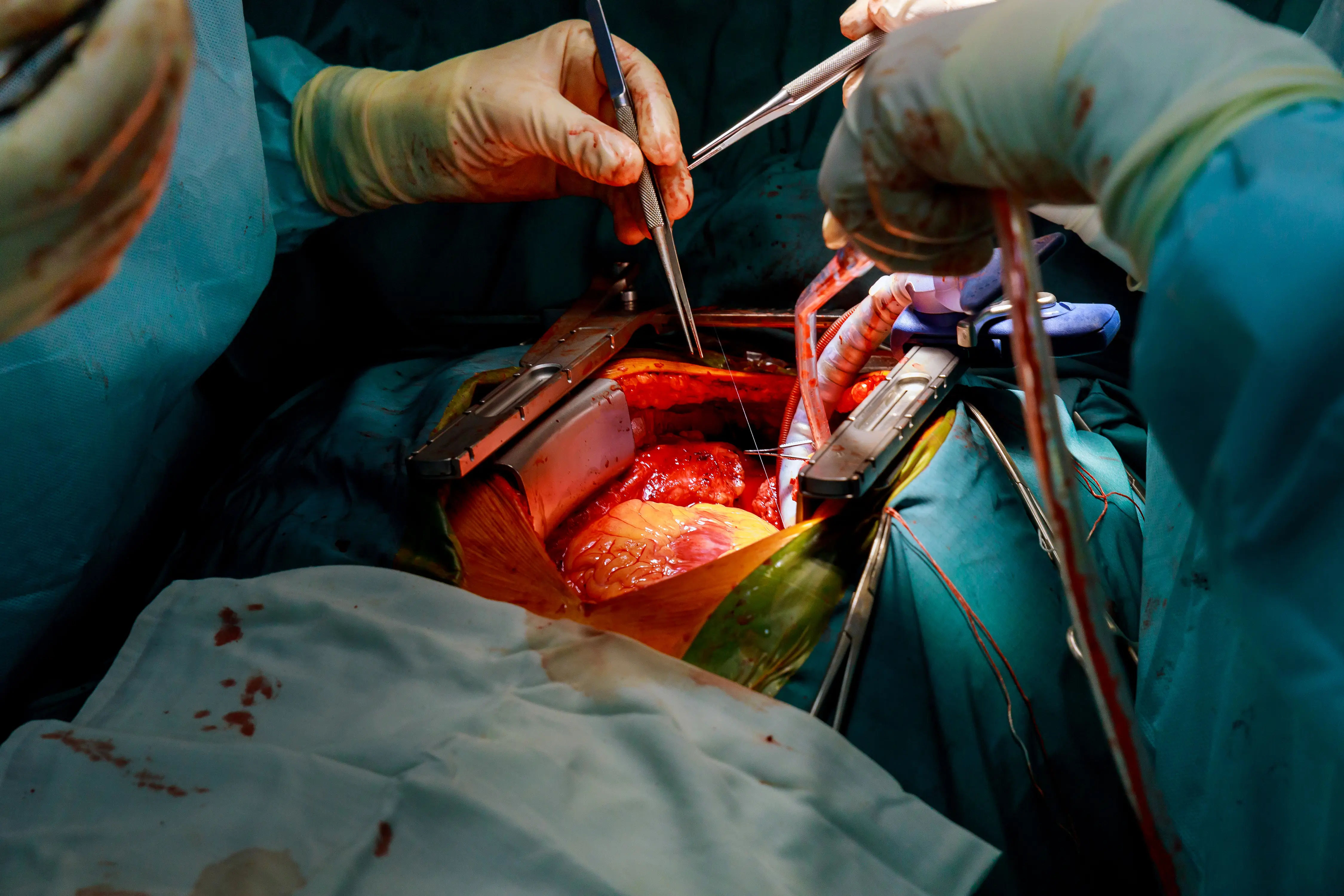 Bypass Surgery