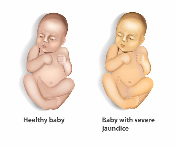 Normal Bilirubin Levels in 7-Day-Old Newborns