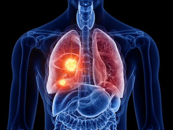 Lung Cancer Awareness Month 2022 Guide