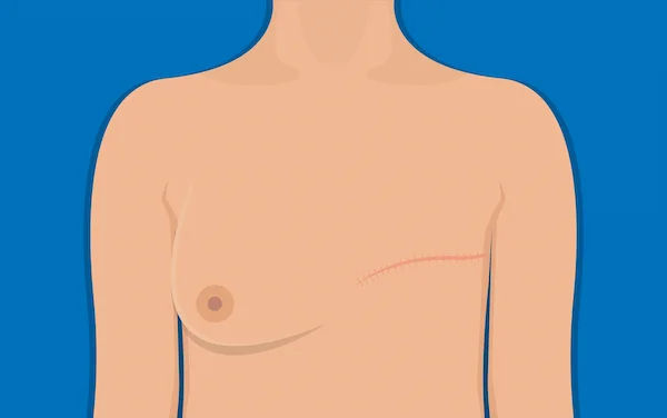 Complication Of Radical Mastectomy