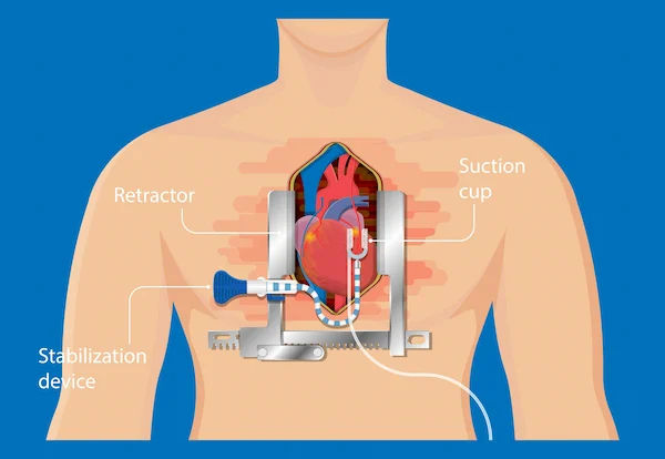 Bypass Surgery Without Opening Chest In India