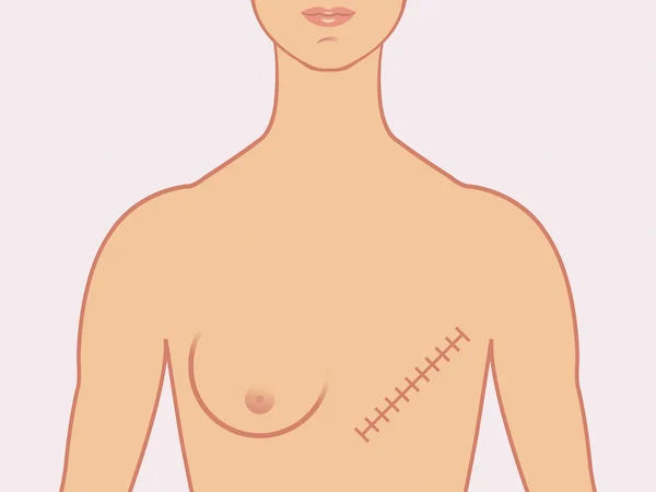 Mastectomy Pre-Op Nursing Care