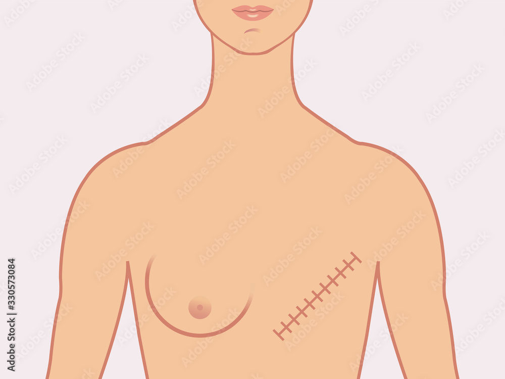 Do You Still Have Nipples After A Mastectomy?