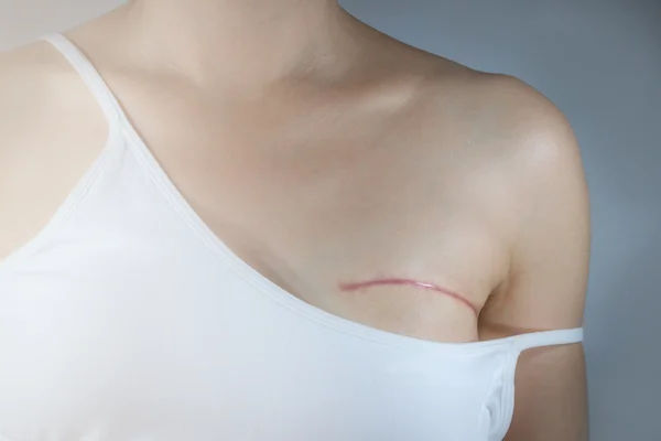 Treatment After Mastectomy Breast Cancer