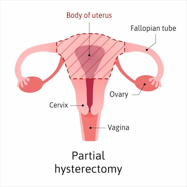 Can the Cervix Be Removed Without a Hysterectomy?