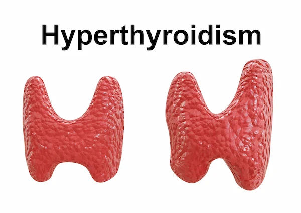 Hyperthyroidism