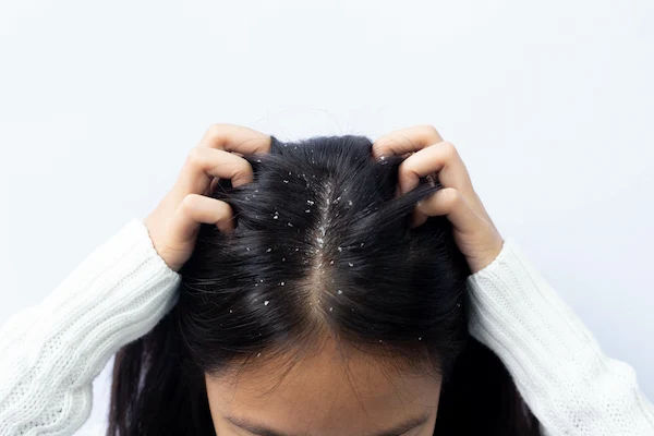 Home Treatments for Dandruff Relief