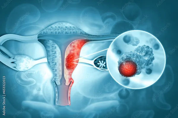 Ovarian Cancer Recurrence After Hysterectomy