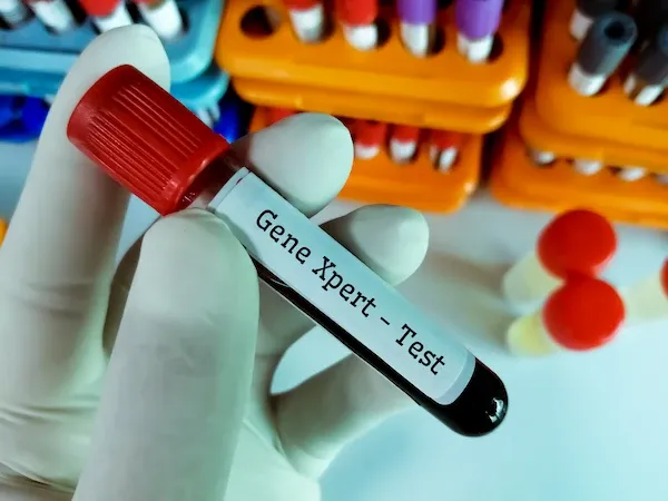 GeneXpert Test