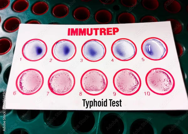 Understanding the Stages of Typhoid Fever