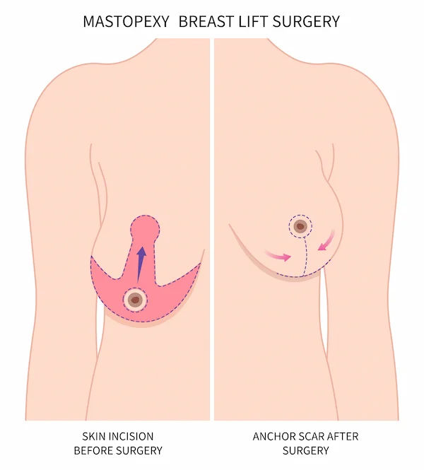 Mastopexy Vs Mastectomy