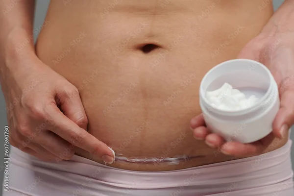 Hysterectomy Problems Years After