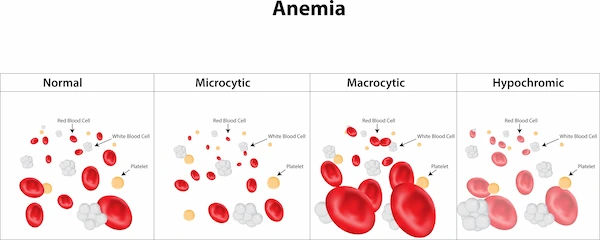 anemia