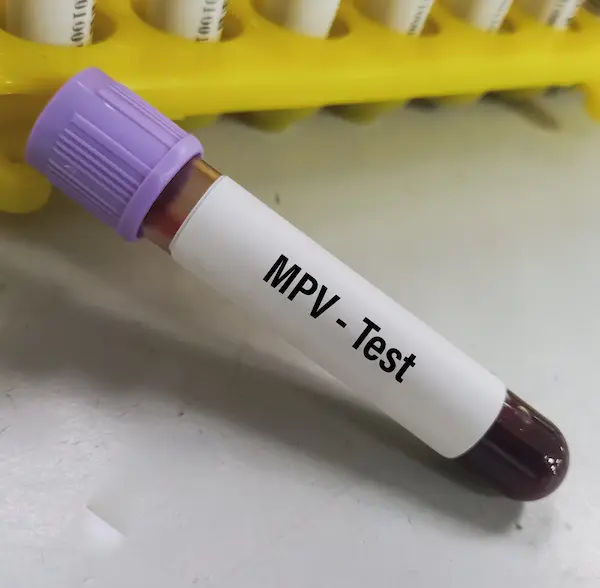 MCV Blood Test