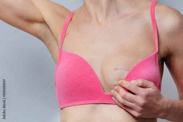 Mastectomy Vs Mammectomy